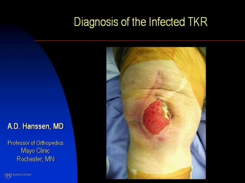 Making the Diagnosis of Infection in TKA - The Latest Tests