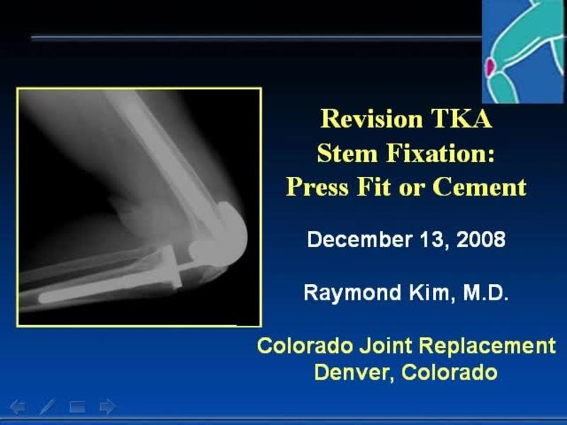 Stem Fixation in Revision TKA - Press Fit or Cement