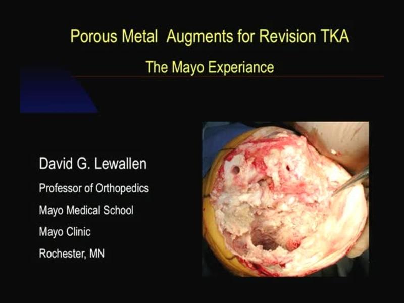 Porous Metal Augments for Revision TKA - The Mayo Experience