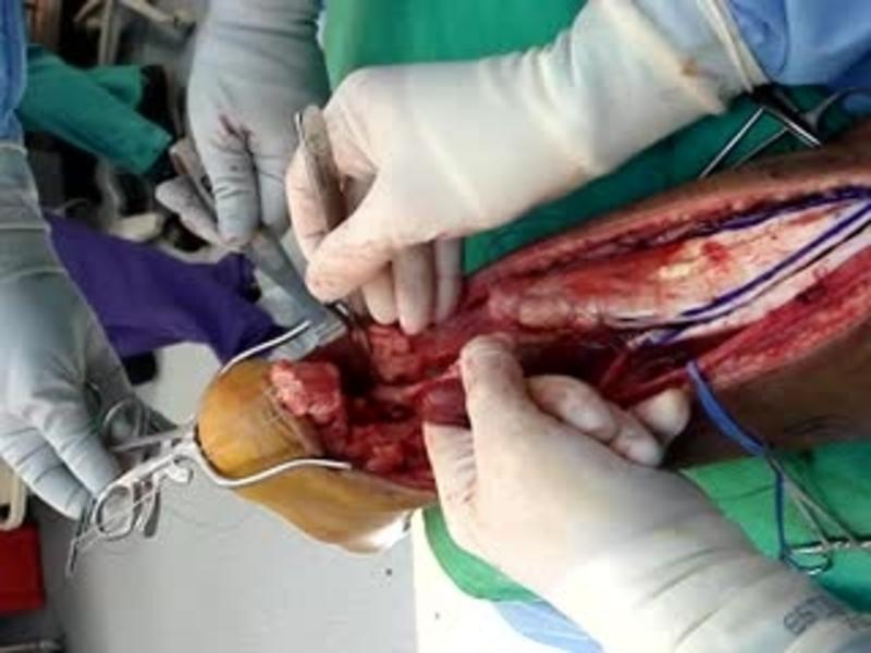 V-Y Advancement and FHL Transfer 5 - Cutting the FHL Tendon