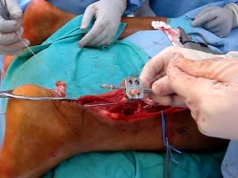 V-Y Advancement and FHL Transfer 6 - Measuring the FHL Graft
