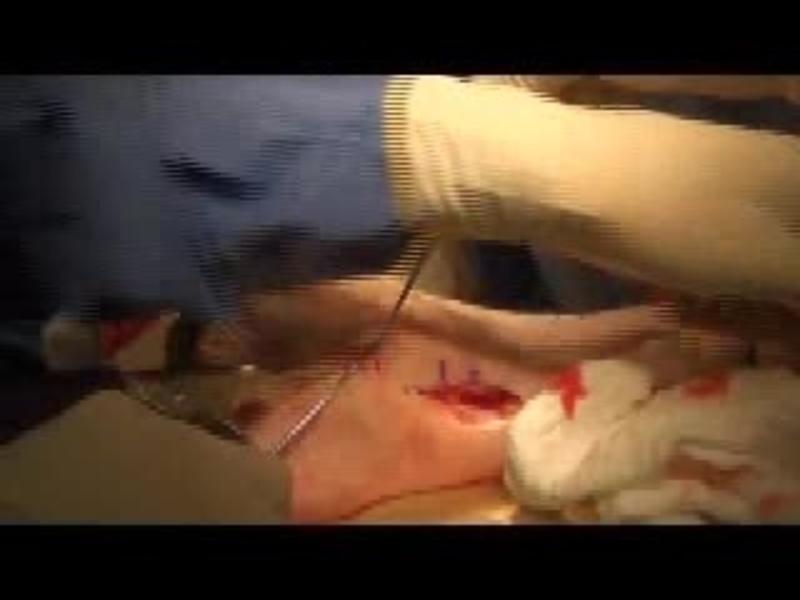 Salto Total Ankle Arthroplasty Medial Malleolus Screw