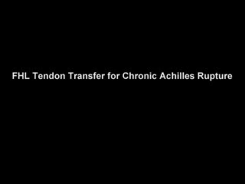 FHL Transfer for Chronic Achilles Rupture
