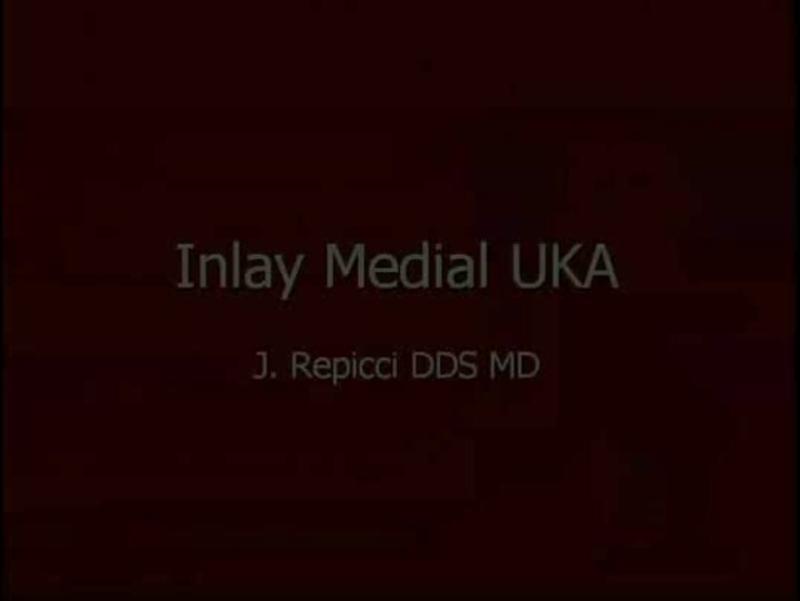 Inlay Medial UKA
