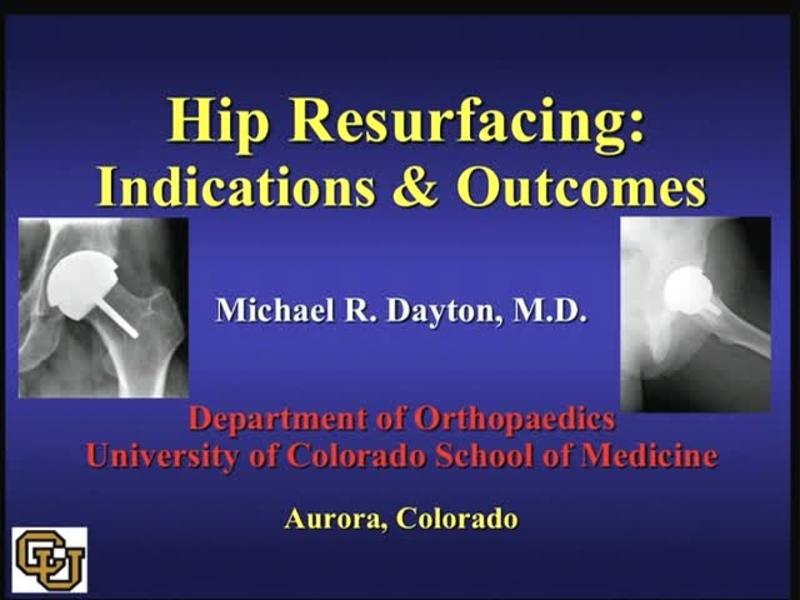 Hip Resurfacing - Indications & Outcomes