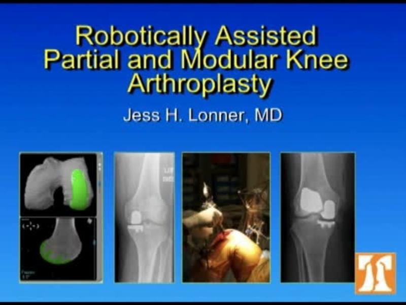 Role Of Robotics In Knee Arthroplasty 