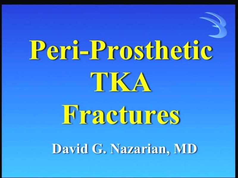 Peri-Prosthetic TKA Fractures