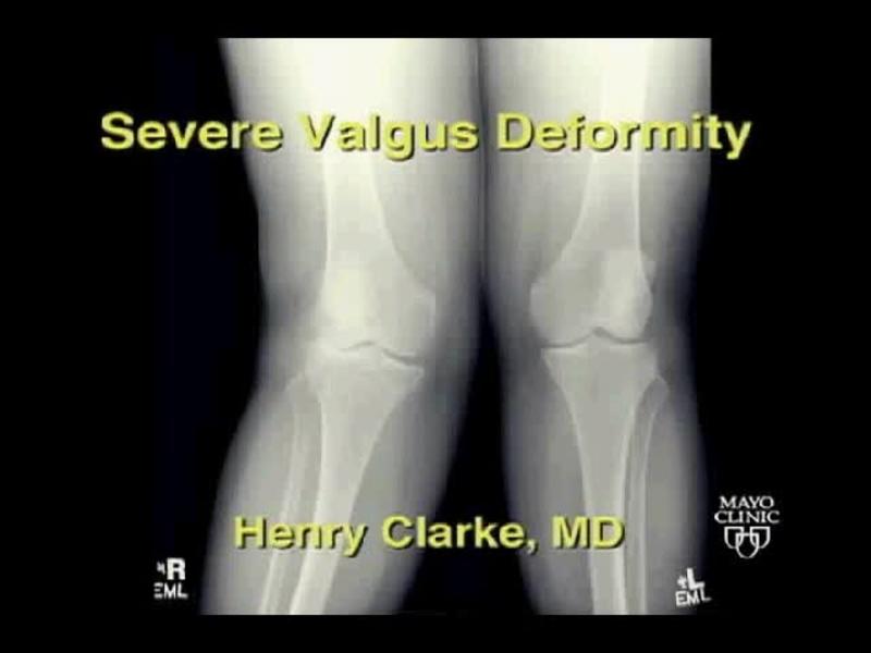The Valgus Knee in Primary TKA