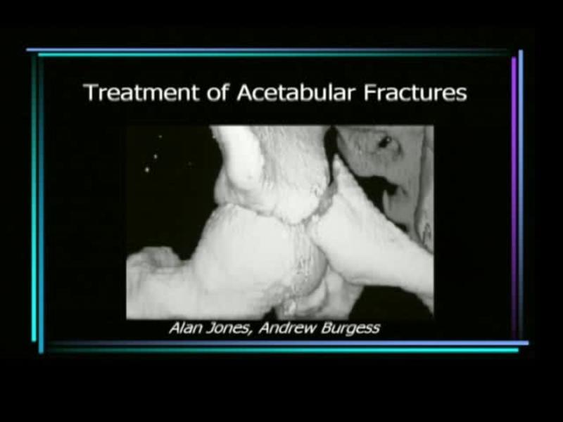 Treatment of Acetabular Fractures