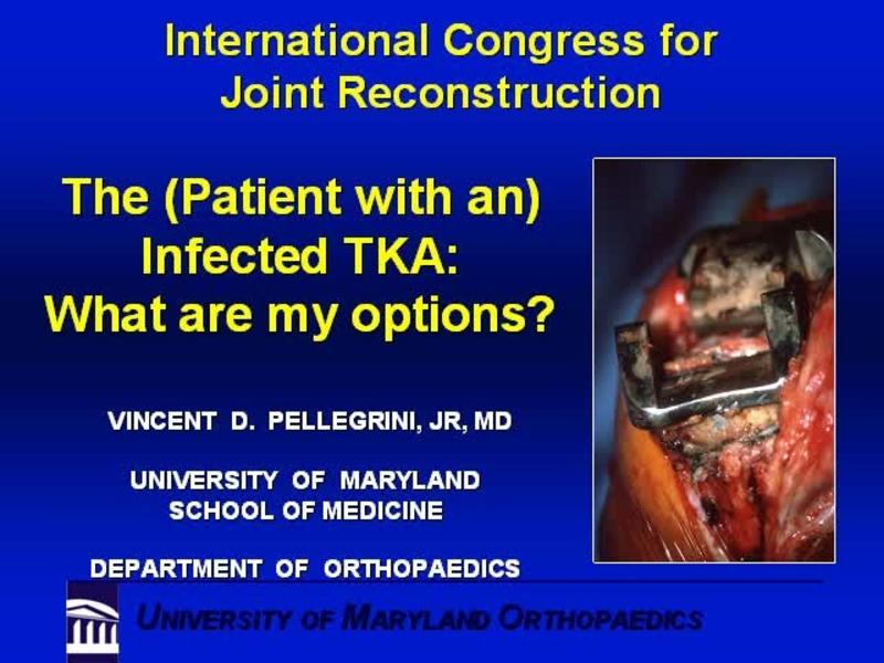 The Infected TKA - What Are My Options