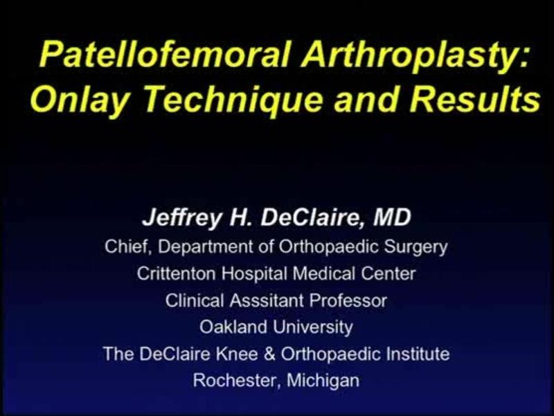Patellofemoral Arthroplasty - Onlay Technique and Results