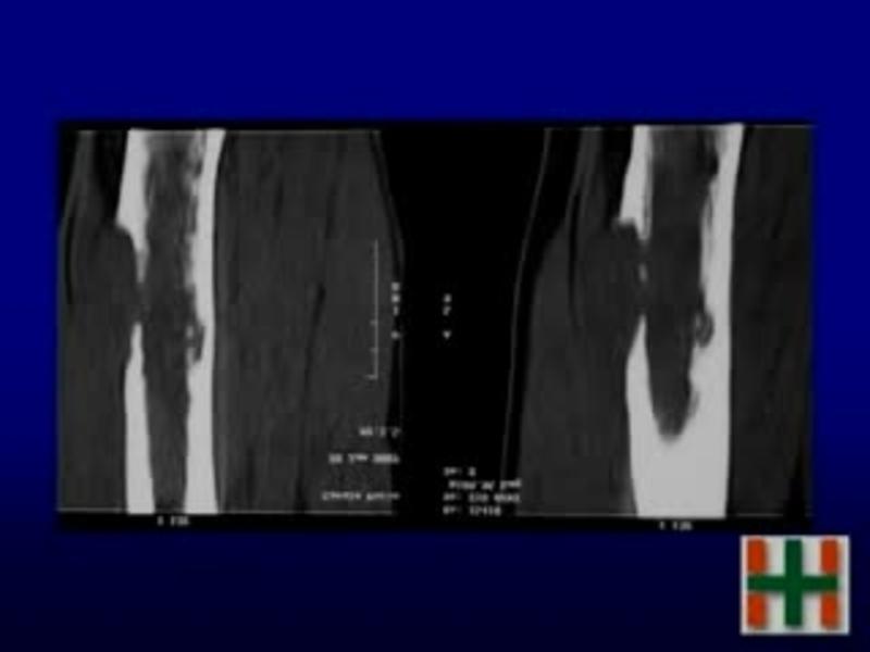 Diaphyseal femur tumor resection and intercalar allograft re