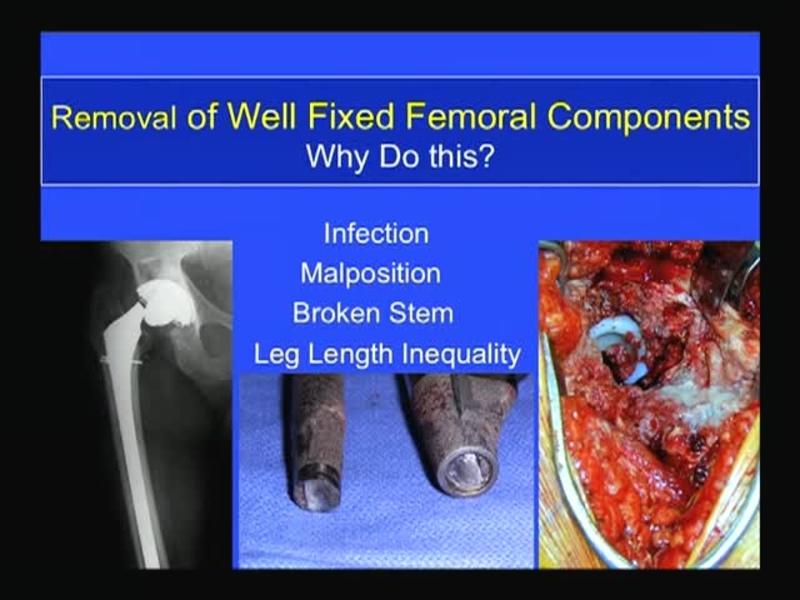 Removal of Well Fixed Femoral Components
