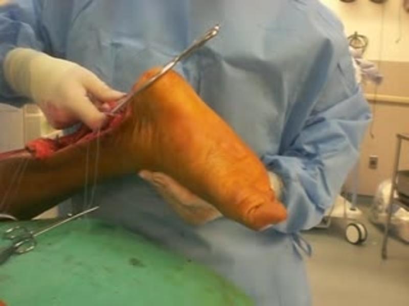 V-Y Advancement and FHL Transfer 4 - Verify the FHL Tendon