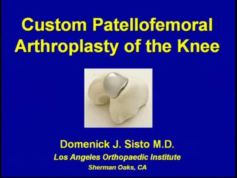 Custom Patellofemoral Arthroplasty of the Knee
