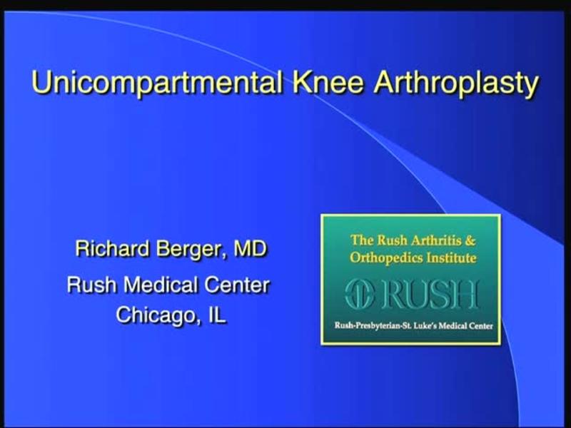 Unicompartmental Knee Arthroplasty - Superb Long Term Result