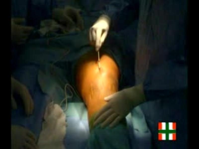 Distal femur osteoarticular allograft