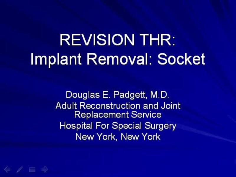Implant Removal - Acetabulum