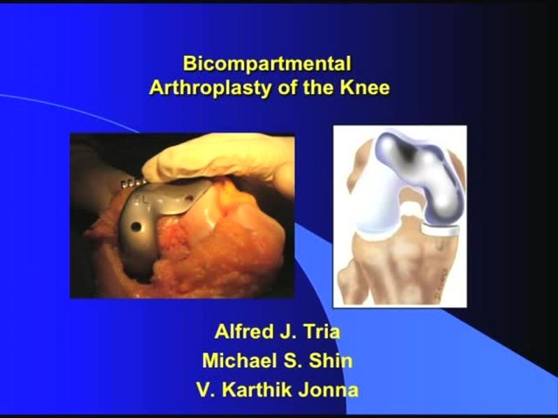 Bicompartmental Arthroplasty of the Knee 