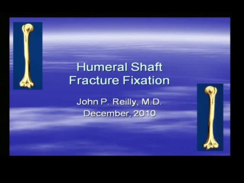 Humeral Shaft Fracture Fixation
