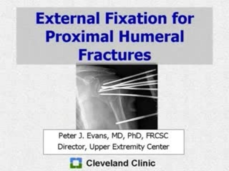 External Fixation for Proximal Humeral Fractures