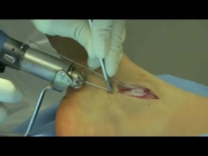 Autologous chondrocyte implantation (ACI) at the talus