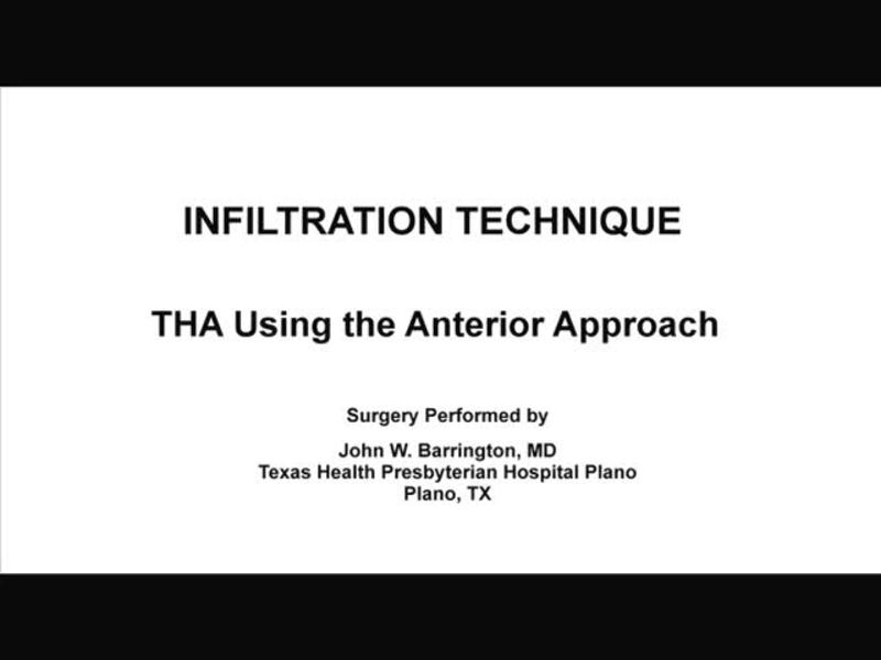 THA Using the Anterior Approach - Infiltration Technique