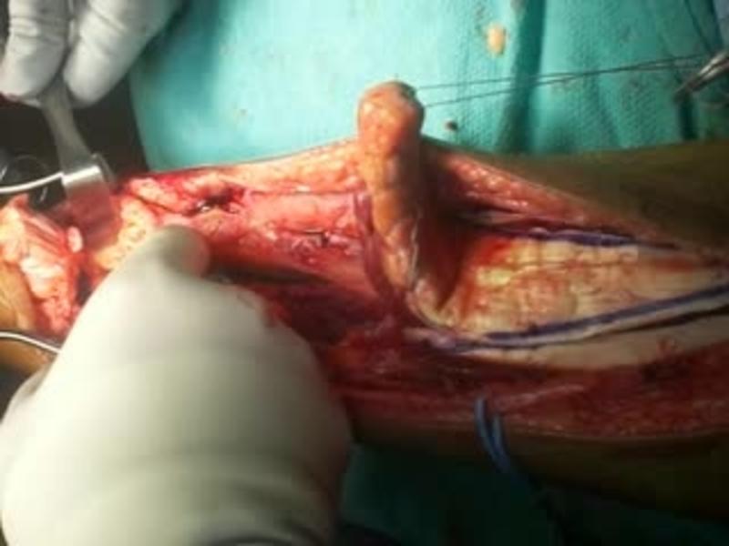 V-Y Advancement and FHL Transfer 3 - Identify the FHL Tendon