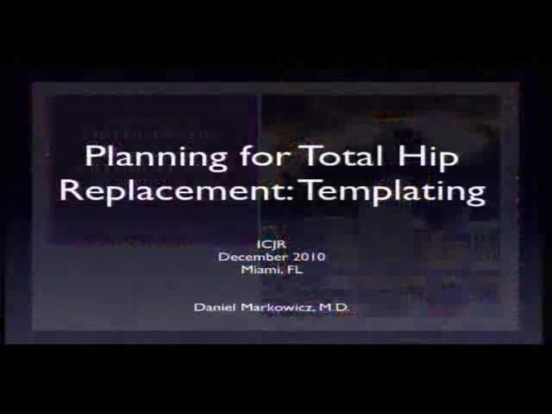 Planning for Total Hip Replacement - Templating