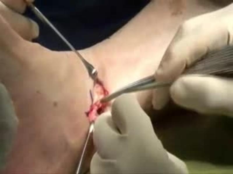 Salto Total Ankle Arthroplasty Protection of Posterior Struc