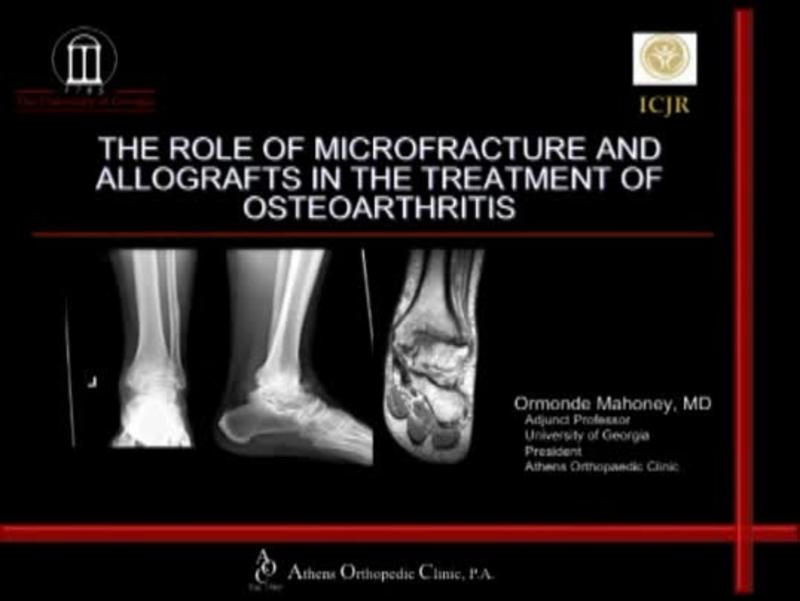 Role Of Microfracture And Allografts In Osteoarthritis 