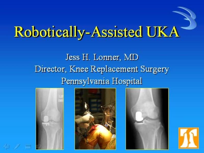 Robotic Unicompartmental Knee Replacement