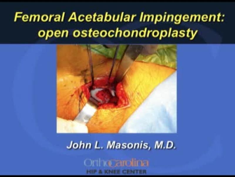 Open Debridement Technique 
