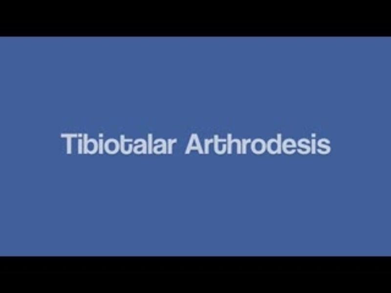 Tibiotalar Arthrodesis