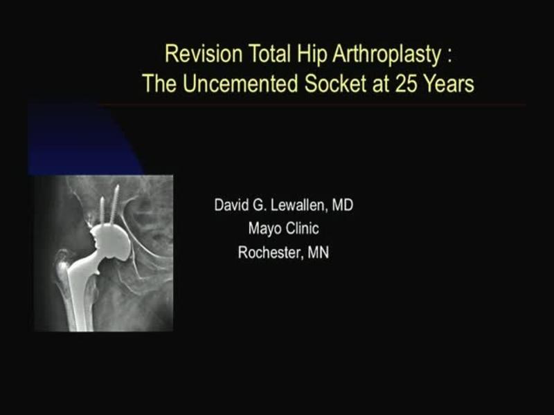 Revision Total Hip Arthroplasty - The Uncemented Socket at 2
