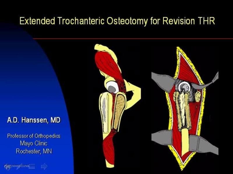 Revision THA Exposure Extended Osteotomy Orthogate